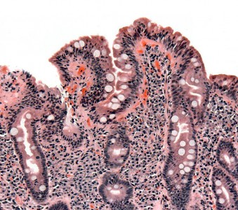 biopsy of small bowel in coeliac disease